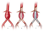 Endovascular