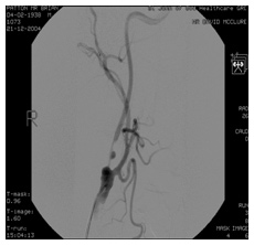 Narrowed Carotid Artery