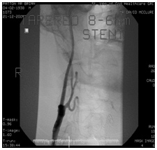 Treated Artery