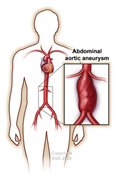 Abdominal-aortic-aneurysm