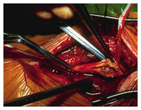 Carotid-endarterectomy-img